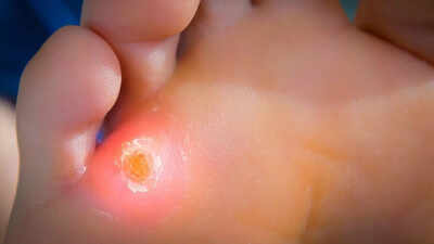 9 effective ways to get rid of calluses at home |