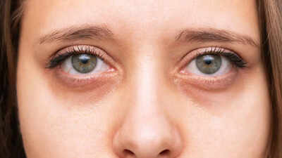 Dark circles under eyes? These vitamin deficiencies could be the cause |
