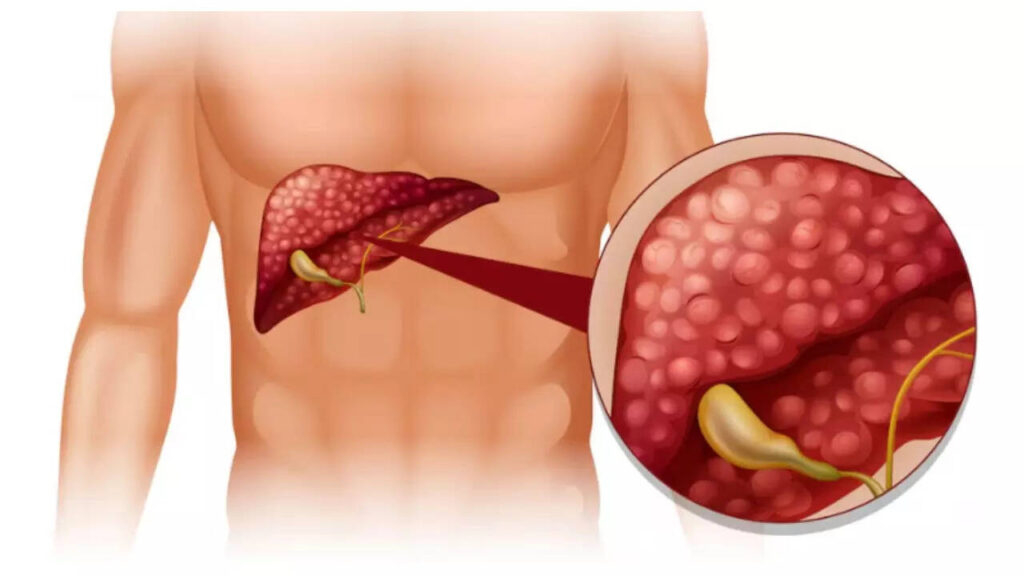 5 early symptoms of Gallbladder Cancer that are easy to ignore