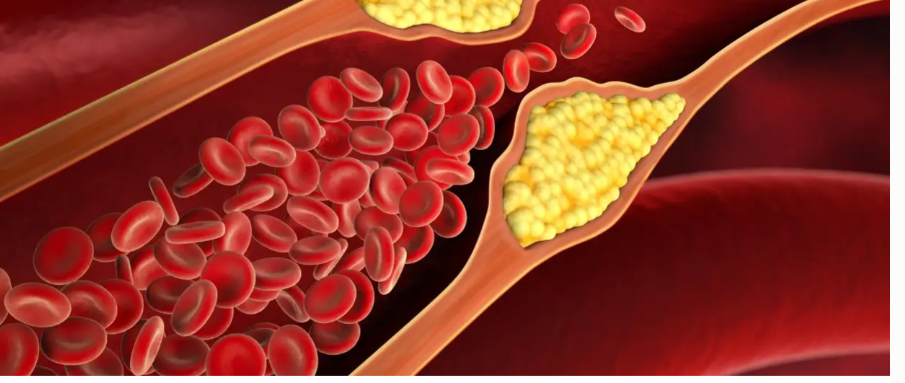 5 supplements that may help lower High Cholesterol