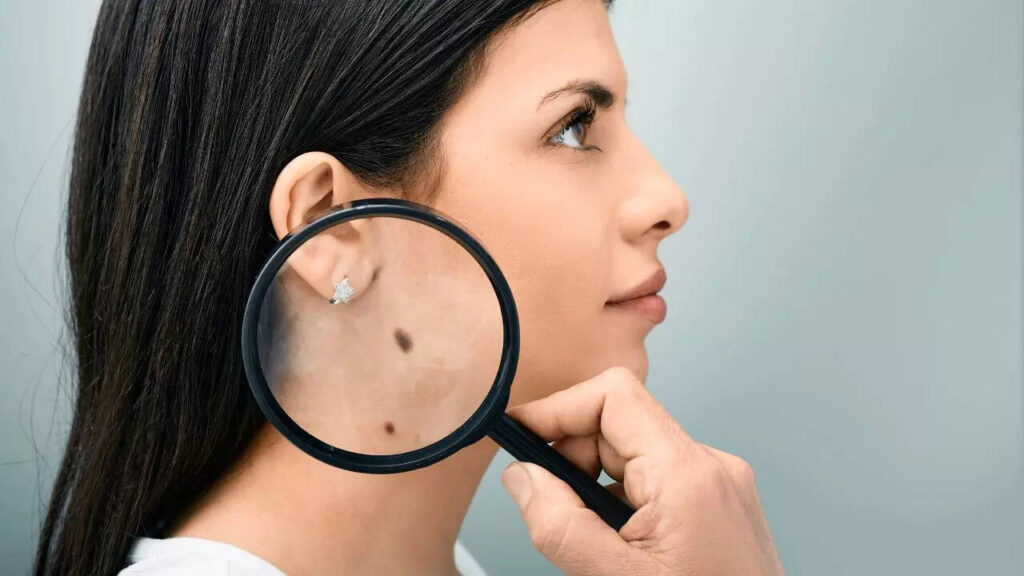 5 diseases moles on your body might indicate and should not be ignored