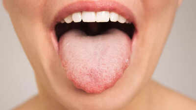 Heart Health: What your tongue says about your heart health |