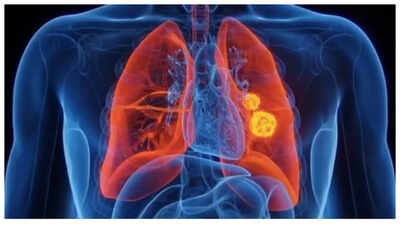 Lung Cancer Symptoms: Lung Cancer rising in young adults – causes, symptoms, and prevention |