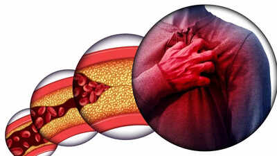 Atherosclerosis early signs in young adults linked to diabetes and obesity |