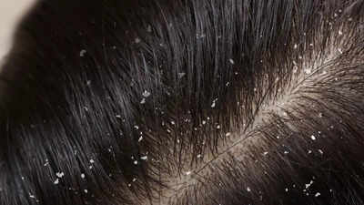 Does coconut oil increase dandruff: The truth about coconut oil and scalp health |