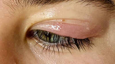 Eyelid problems and disorders explained: Causes, symptoms, and effective treatments |