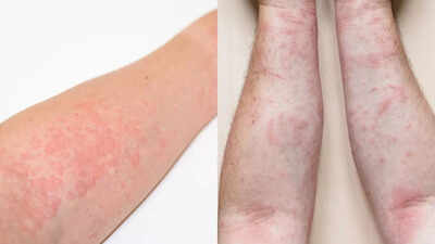 Hives vs rashes: Spot the signs, understand causes, and tips to manage effectively |