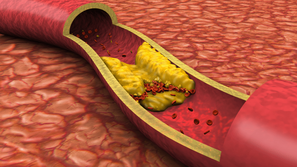 6 early signs of blocked arteries that appear in the legs