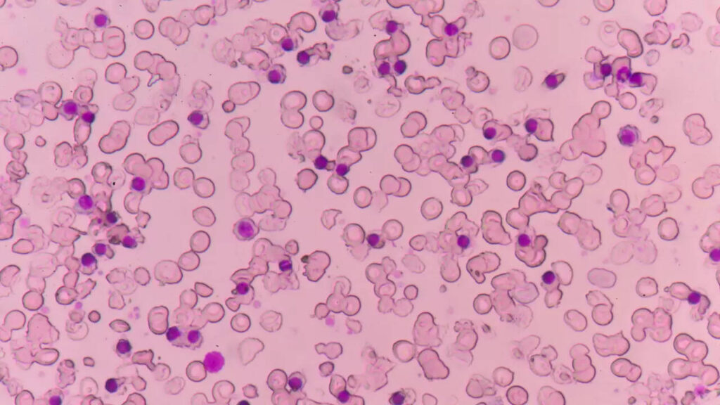 What is Alpha Thalassemia? How is it diagnosed?