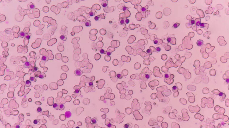 What is Alpha Thalassemia? How is it diagnosed?