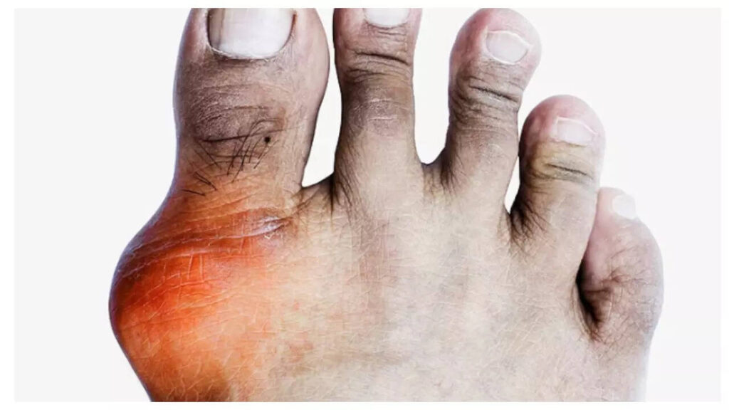 5 natural ways that can help bring down Uric acid in 3 months