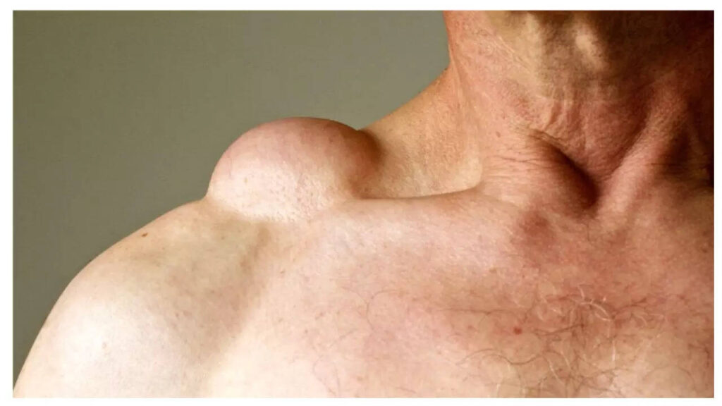 Mimicking a viral infection, 5 early symptoms of Lymphoma that one must not ignore