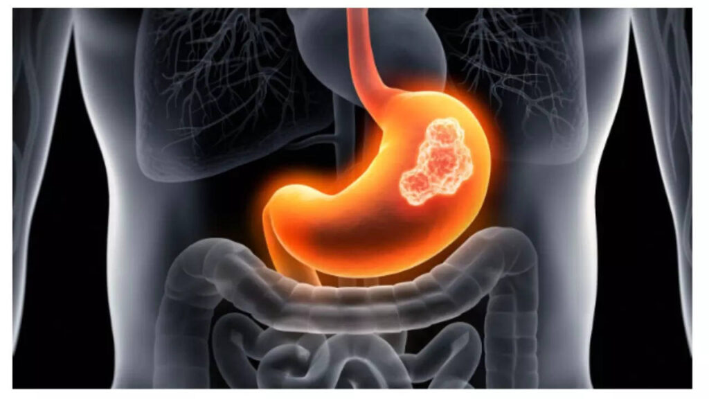 5 foods that can help keep stomach cancer at bay