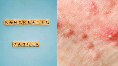 Pancreatic symptoms on skin: Early signs you shouldn’t ignore |