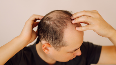 Balding (hair loss) is inherited from father’s or mother’s side? This is what Science says |
