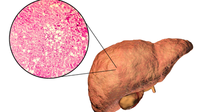 Non-alcoholic Fatty Liver Disease (NAFLD): What really causes it and how to fix it