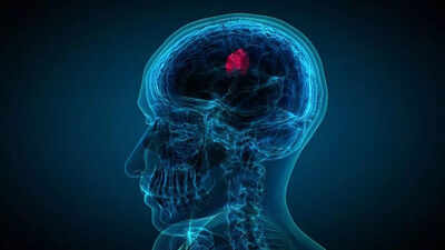 Early warning signs of brain tumour that you should never ignore |