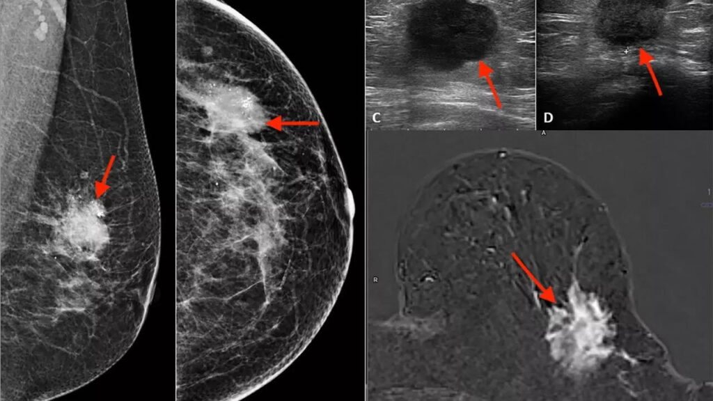 Cancer alert: Lesser-known breast cancer surging in US; what is it and the red flags to watch for