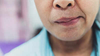 Facial paralysis warning signs: Key causes, symptoms, and prevention tips for sudden or gradual facial nerve damage |