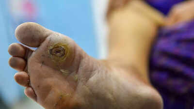 High blood sugar slowly damages your feet: Causes, symptoms and science behind diabetic foot ulcers |