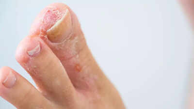 How to get rid of athlete’s foot naturally: 10 simple home remedies |
