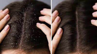 How to get rid of oily and sticky dandruff: 10 tips for a healthy scalp |