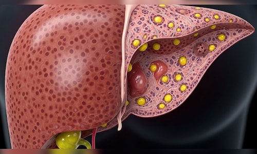 Non-alcoholic fatty liver disease: All you need to know about it