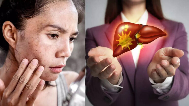 Dark spots on skin and its link with liver: 5 things to know