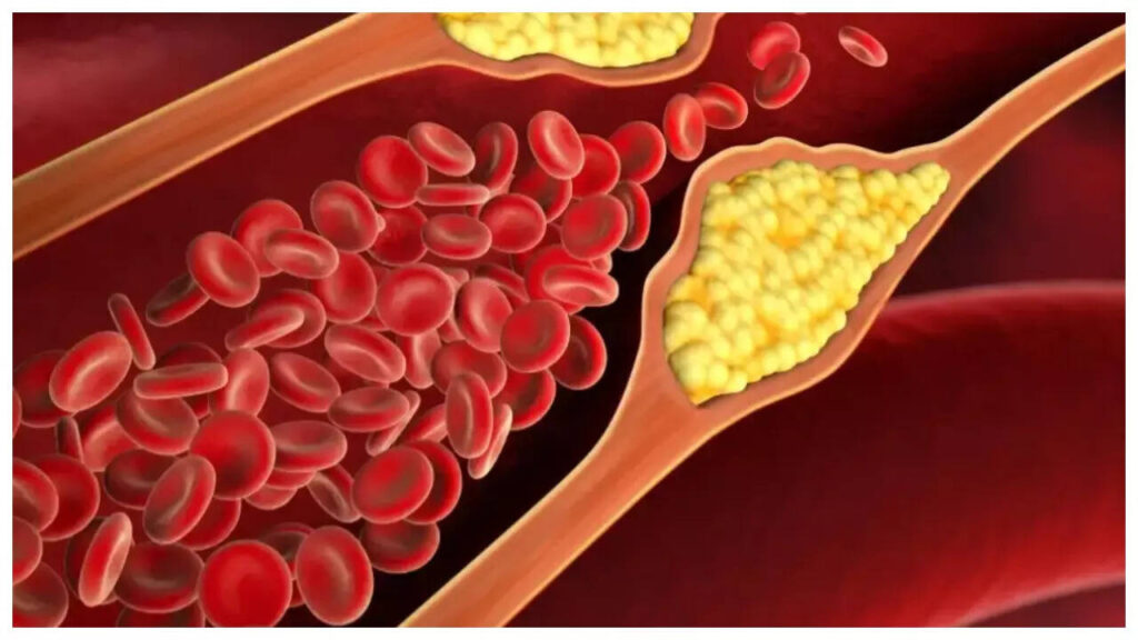 5 natural foods to help bring down cholesterol in 3 months