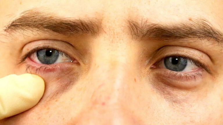 5 eye symptoms that may reveal underlying health issues