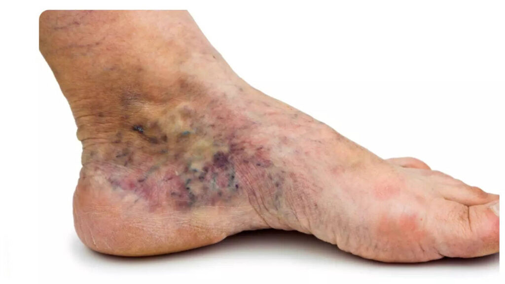 6 warning symptoms of Peripheral Artery Disease (PAD), as revealed by top vascular surgeon