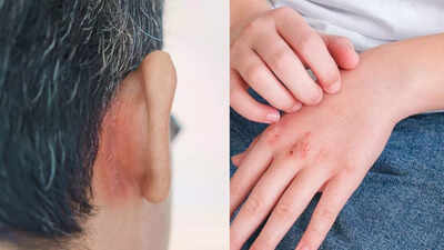 Parkinson’s disease symptoms on the skin: Dry skin, itching, and more