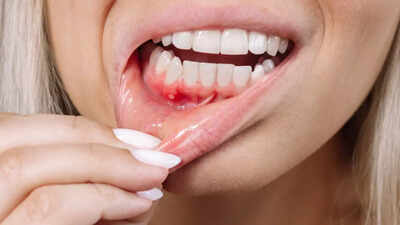 Persistent bleeding gums: Here are the diseases that could be causing it |