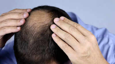 Prevent hair loss with these essential vitamins and minerals |