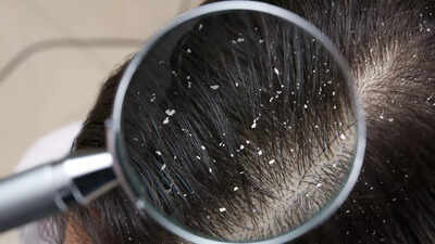 Treat your dandruff right: Identify your type for flake-free scalp |