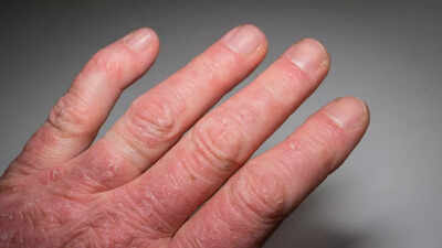 What is Psoriatic Arthritis: Know its signs, causes, and how to manage |