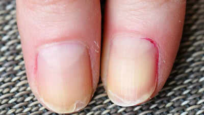 Why are your nails peeling: Know medical issues, causes, remedies, and prevention guide |