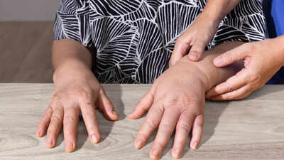 Why your hands swell: Common causes and treatment options for oedema |