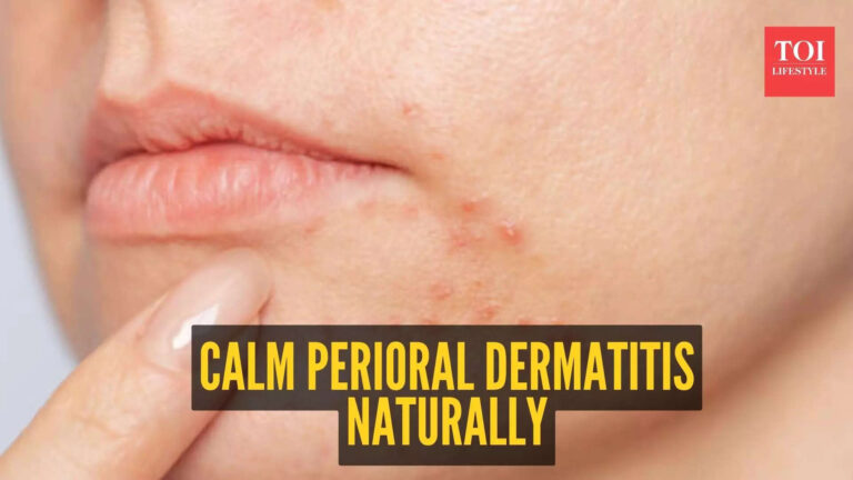 5 natural home remedies to deal with Perioral Dermatitis
