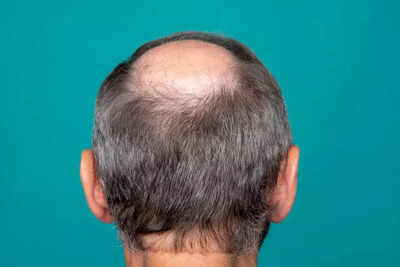 Hair Loss: Men across India are going bald – but researchers say the real reason may shock you