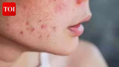 Why your acne scars won’t go away — science finds the real reason | India News